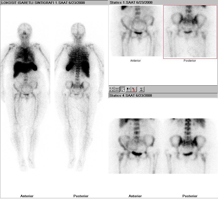 56 Resim 5b. Grup I, 2 nolu hastanın İLs görüntüsü. Sol asetabular bölgede patolojik fokal Tc-99m HMPAO uptake i izlenmektedir. Resim 5. Grup I, 2 nolu hasta (sol kalça protezli) nın sintigrafi görüntüleri.