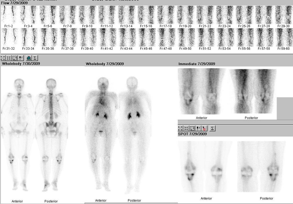 Resim 8a. Grup II, 13 nolu hastanın üç fazlı Ks görüntüsü.