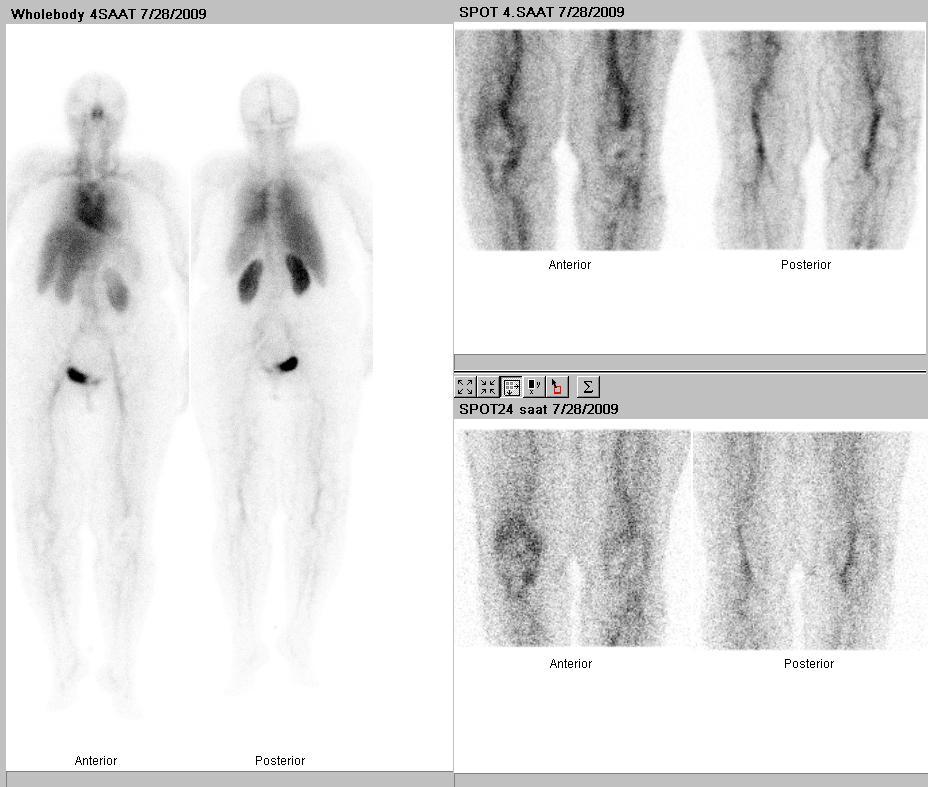 67 Resim 8c. Grup II, 13 nolu hastanın HIGs görüntüsü. Ks inde fokal osteoblastik aktivite artışı izlenen bölgede patolojik Tc-99m HIG uptake i izlenmiştir. Resim 8. Grup II, 13 nolu hasta (sağ diz protezli) nın sintigrafi görüntüleri.