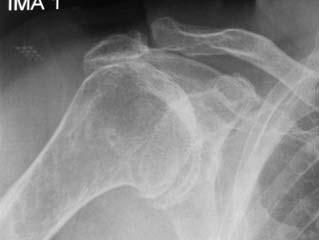 Glenohumeral osteoartrit nedenleri. Şekil 4. GHE OA radyolojik bulguları.