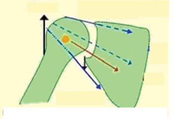 mesafesinin arkadan daralması, subkondral skleroz, osteofit Subgrup B2: Pesterior glenoid erozyon ve bikonkavite teras minor Rotarotor Kaf Dinamik Stabilitesi evre 4b supraspinatus evre 5 Evre 1: