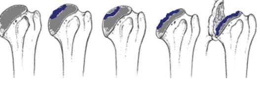 Türk Fiz T p Re hab Derg 2012;58:236-42 Glenohumeral Osteoartrit Nedenleri 239 grafi ile konur.