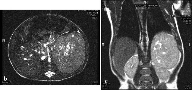 Resim 2 b, c. Aksiyal (b) ve koronal (c) MRG kesitlerinde; karın sol üst kadranı dolduran, sol adrenal yöresinde yerleşmiş dev solid kitle. Patoloji tanısı; adrenokortikal karsinom.