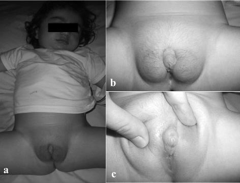 F. Andıran, Adrenal tümörler Resim 3 a, b, c. Dış genital bölgede değişim yakınması ile başvuran 2 yaşındaki kız çocuğunda, labiumlarda belirginleşme, kıllanma, klitoris hipertrofisi görülmekte.