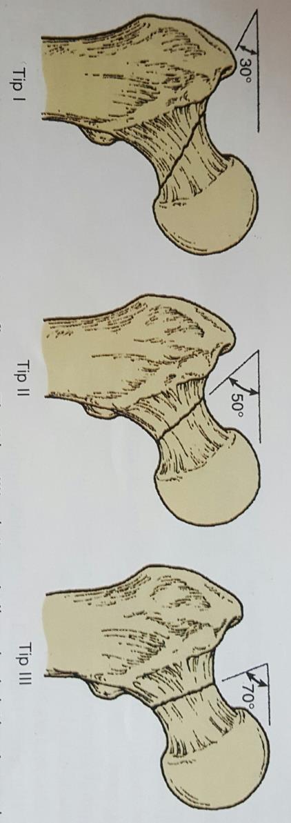 Resim 2. Femur boyun kırıklarında Pauwell sınıflaması (21). Tedavi Günümüzde femur boyun kırıklarında bir çok cerrahi tedavi seçeneği mevcuttur.