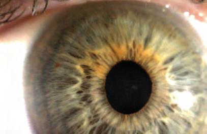 Göz tahrişi, kir, böcek veya bilinmeyen nesne vakaları Iriscope yardımı ile tespit edilebilir ve tedavi için doğru teşhis sağlayabilir.