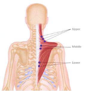 Farklı Bir Bozucu Alan Nedeni: Hacamat Şekil 1 Trapezius, Levator scapulae, Rhamboid Minor tetik noktalar. tan Ubi Plethore Ibi Evacua adlı eserdir. (7) Ebers Papirus da (Mısır da) M.Ö.