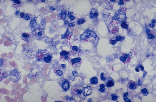 BOS 24 saat bekletildi: Fibrin ağı (+) Fibrin ağından EZN boyası: Mikrobiyoloji Lab dan beklenenler: Hızlı tanı: PCR duyarlılığı