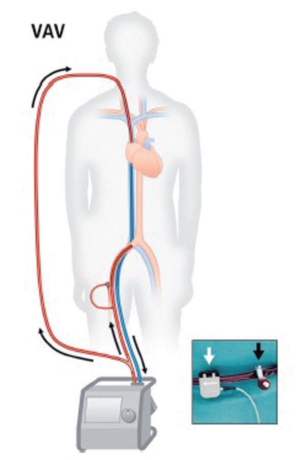 VENO-ARTERİYEL-VENÖZ ECMO (VAV) Bu konfigürasyon eş zamanlı akciğer ve kalp yetmezliği bulunan hastalarda kullanılarak arteryel akım bir kısmı aorta doğru ve bir kısmı sağ atriyuma doğru olmak üzere