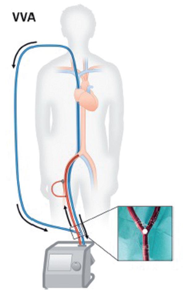VENO-VENO-ARTERİYEL ECMO (VVA) Bazı veno-arteryel ECMO olgularında (örneğin ven çaplarının küçük olması durumunda veya yüksek akıma bağlı hemoliz olgularında) tek bir venöz kanül ile drenaj