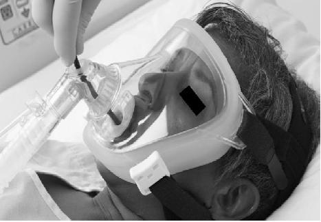 NIMV eşliğinde bronkoskopi Trakeal lümende daralma Havayolu rezistansında artış Tidal volümde azalma Mukozaya irritan etki ile trakea/bronş spazmı Topikal anestezik, salin