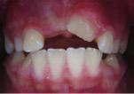 Aynı zamanda, 21 no lu dişin erüpsiyon yönünün farklı olması nedeni ile hastanın ortodontik tedavi görmesine karar verildi. Resim 3a,b,c,d.