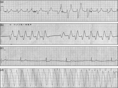 5, minor EKG değişikliği) Moderete (6.6-8, T sivriliği) Ciddi >8 ya da QRS genişlemesi, AV blok, ventriküler disritmi.