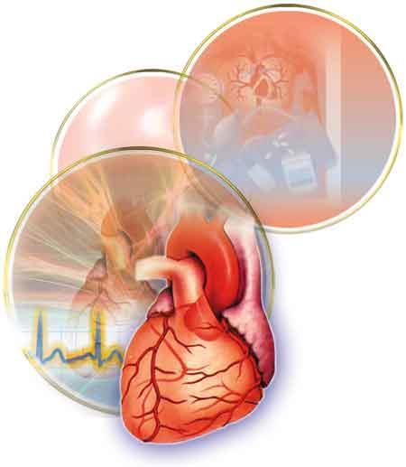 Diyabetin Kronik Komplikasyonları Makrovasküler Komplikasyonlar Ateroskleroz Hipertansiyon İskemik Kalp