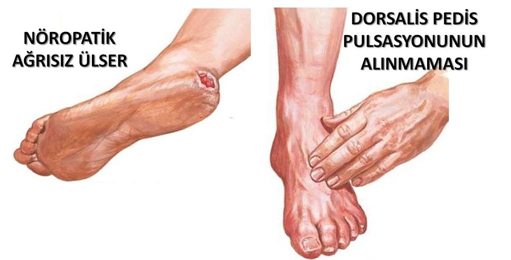 Diyabet hastalarının bacak veya ayaklarında meydana gelen damar tıkanıklığı sonucunda