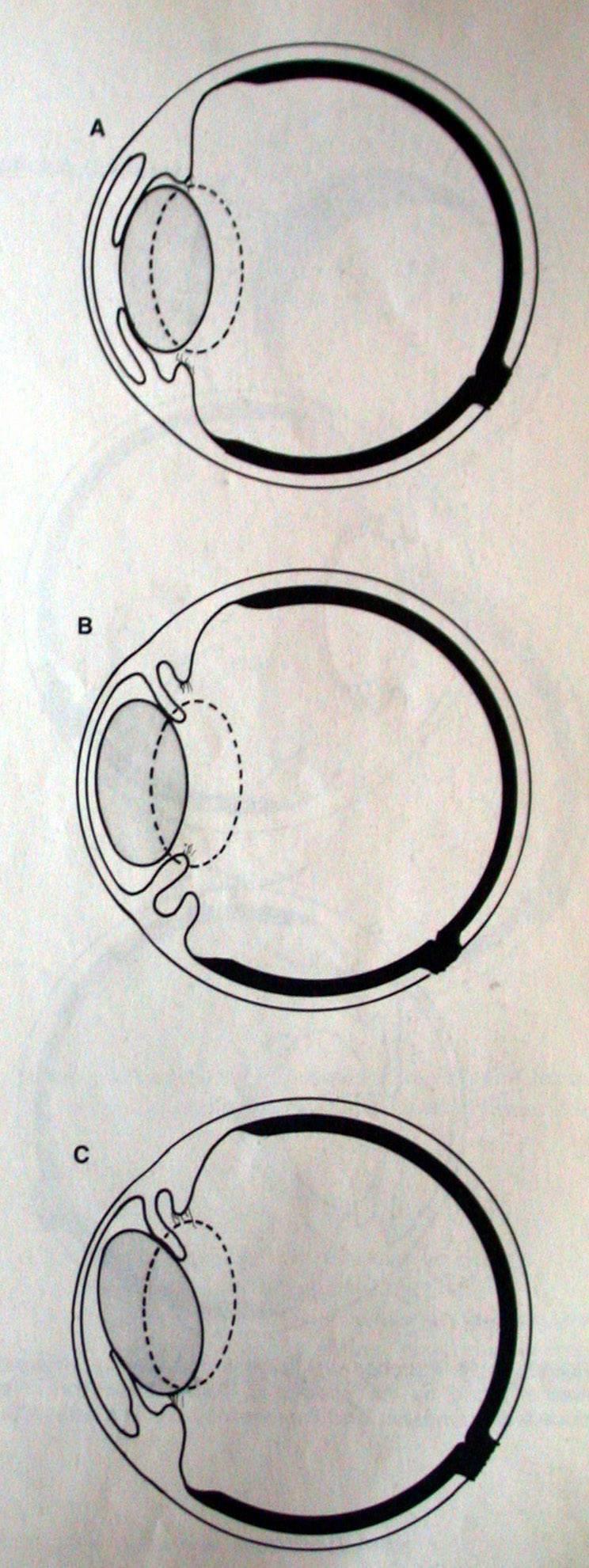 ANTERİOR LENS LUKZASYONU Anterior lens lukzasyonu (iris öne gelir, pupillar