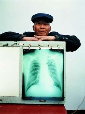 Akciğer Grafisi Yayma (-)( ) hastaların tanısında nda önemi vardır Hemen her zaman radyolojik