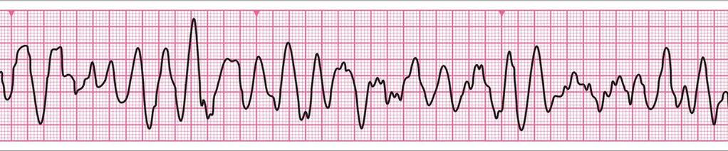 Garip - düzensiz dalga Tanımlanabilir QRS kompleksi yok Frekans ve