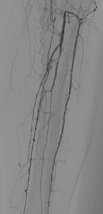 Arterial kalsifikasyon 2 ayrı bölgede gelişir: büyük ve orta boy arterlerin