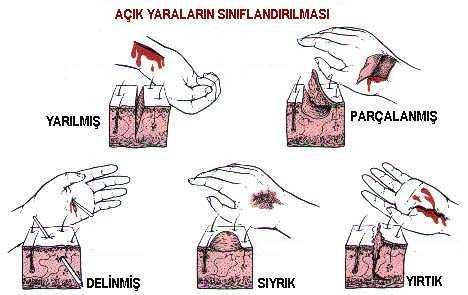 6 YARA ÇEŞİTLERİ VE İLK YARDIM Yaralar değişik