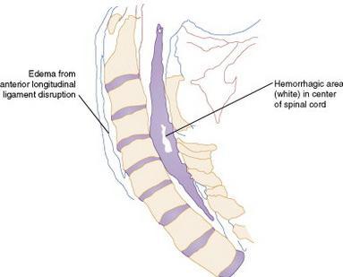 Spinal Kord Yaralanmaları SCIWORA Spinal Cord Injury Wıthout