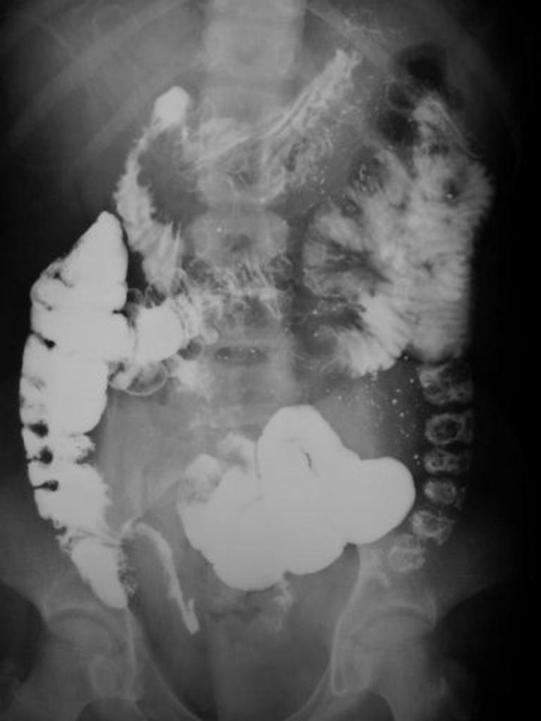 Tanı-2 Karakteristik radyografik bulgular; ince bağırsakta bölgesel daralma, yıkılmı normal mukozal patern