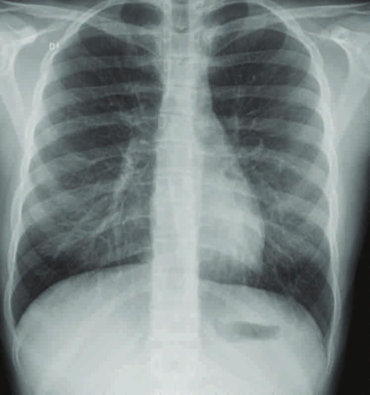 48 Ek II Şekil 18: İlk akciğer röntgeninden