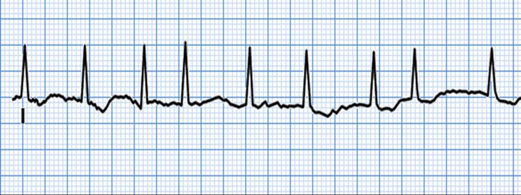 ATRİYAL FİBRİLASYON En sık rastlanan aritmi Aritmiye bağlı hastaneye yatışların %33 ünü oluşturur Stroke