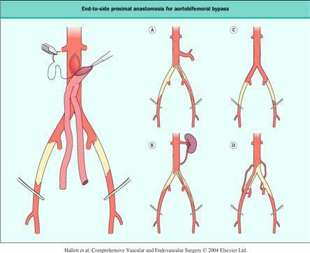 Aorta İliak Arter Hastalıklarının Cerrahi Tedavisi Tromboendarterektomi Bypass cerrahisi