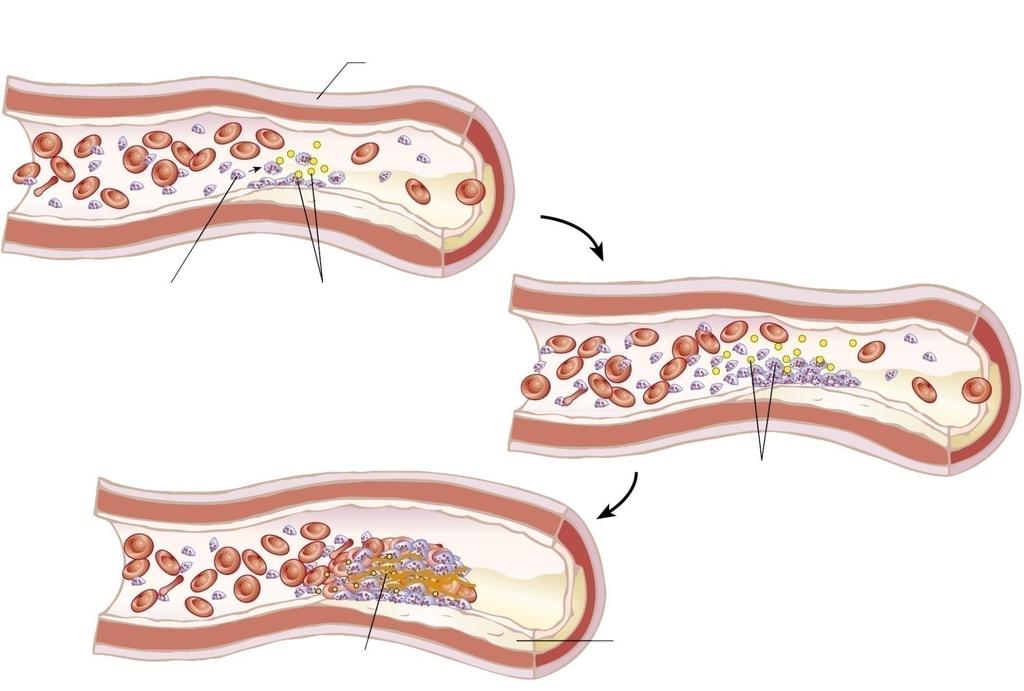 Tromboz Gelişiminde Hücresel Süreç Platelet yapışması Vazokonstriksiyon Dolaşımdaki platelet trombojenik subendotelyal damar duvarı bileşenlerini algılar (örn. kollajen) 2.