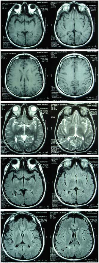 Şekil 2: Sağ temporooksipital bölgede T2- ağırlıklı ve FLAIR serilerde azalmış hiperintens lezyonlar TARTIŞMA SE sonrası nöronal hasarın neokorteks, hipokampüs, serebellum ve talamusta geliştiği