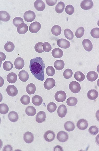 M6 AML Anemi ve anormal dolaşan eritroblastların