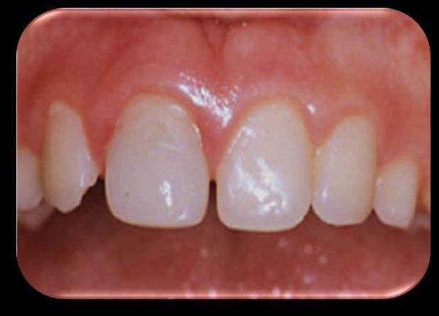 incisor before