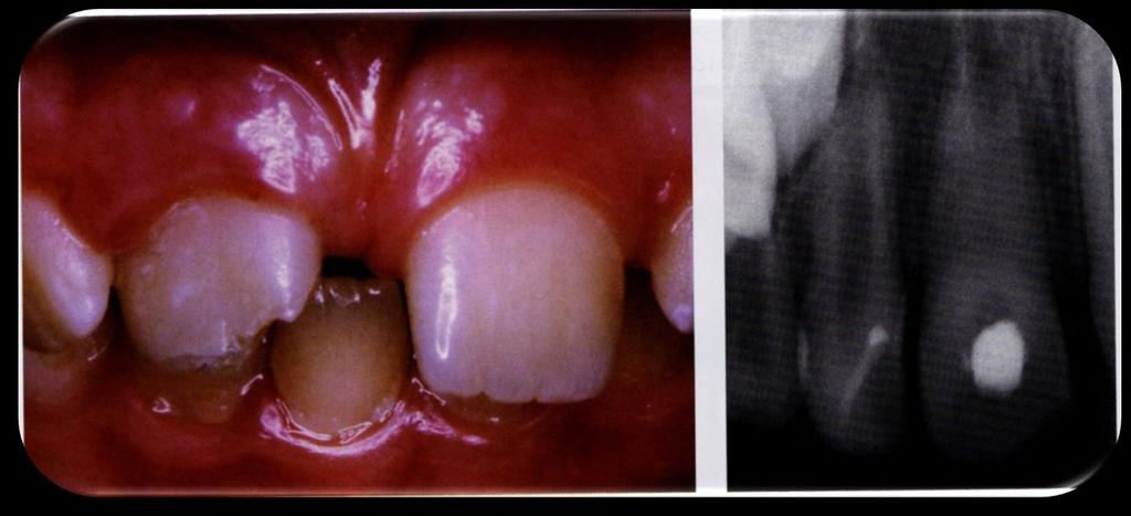 Orthodontic management of the traumatized