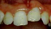 teeth--treatment options for the