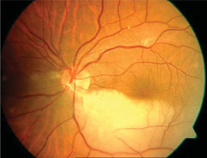 64 Retina Arter Dal Tıkanıklığında Optik Koherens Tomografi Bulguları OLGU1 Ellidört yaşında bayan hasta 2 gün önce sol gözünde ani gelişen üst kadranda