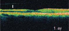 ay kontrolünde tıkalı arterlerin yeniden kanalize olduğu ve mevcut beyazlaşma ile retina ödeminin gerilediği görüldü (Resim 1). Sol göz GK sı 20\40 idi.