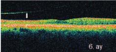 Retina kalınlığının 224 μm ye gerilediği saptandı. FRT ve RPE koryokapillaris kompleksi reflektivitesinde ise artış olduğu görüldü.