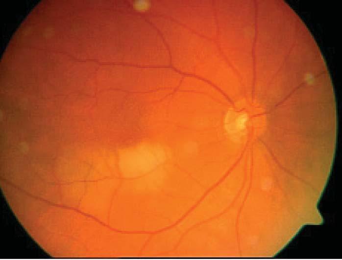 66 Retina Arter Dal Tıkanıklığında Optik Koherens Tomografi Bulguları Resim 5: Olgu 3. Akut dönem (sağ) ve 1.