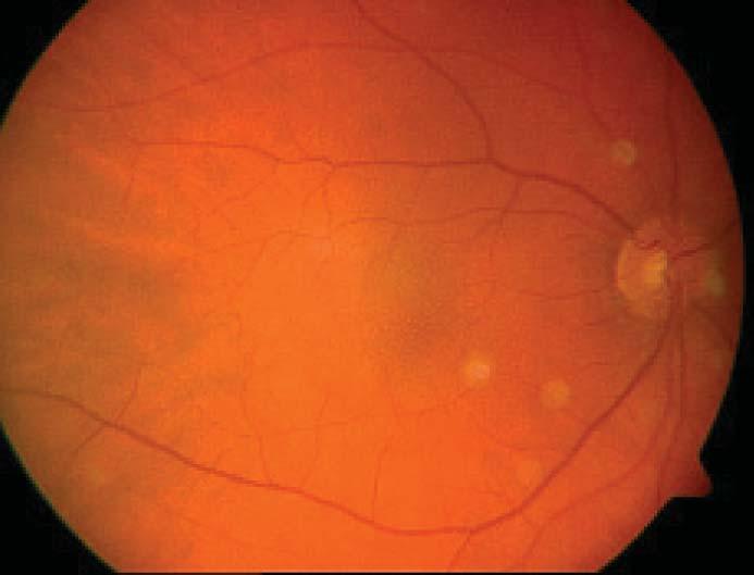 Sağ gözde GK sı 20\63, sol gözde ise 20\25 olarak tespit edildi. Ön segment muayenesinde her iki gözde nükleer skleroz tespit edildi.