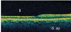 İç retina tabaka reflektivitesi ve kalınlığının 1. aya göre azaldığı, dış retina tabaka reflektivitesinin ise arttığı görüldü.