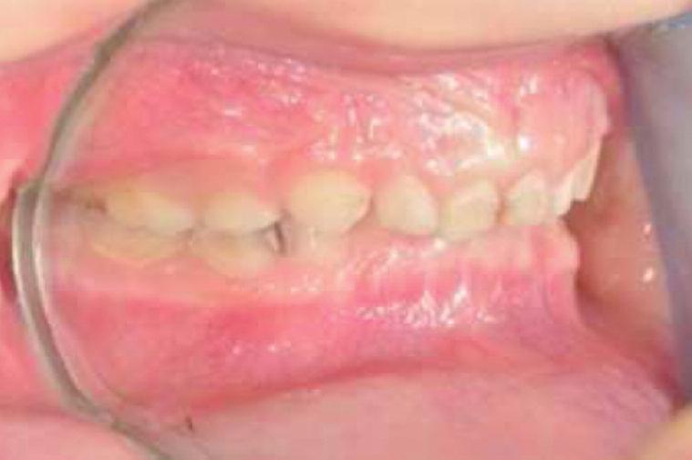 Süt Kanin Dişlerinin Kapanış İlişkisi Süt dişlenme dönemindeki kaninlerin interokluzal ilişkisi daimi dişlerdeki okluzyonun önemli belirleyicilerinden biri olarak kabul edilmektedir.