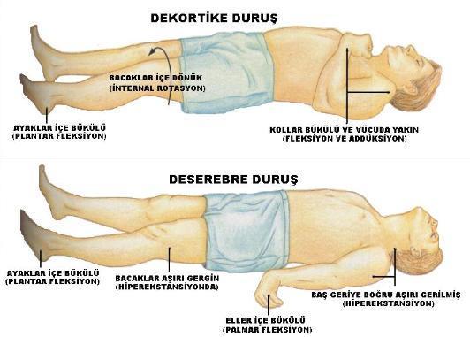 GKS E (eye göz yanıtı) M (Motor motor yanıt) V (Verbal sözel yanıt) E4 spontan açık M6 emirlere uyuyor V5 oryente E3 söz ile açık M5 ağrıya lokalize V4 konfüze E2