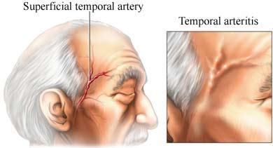 Temporal arterit Sedim genellikle >50 CRP >2.45 Önce görme değişiklikler, sonra körlük gelişir.