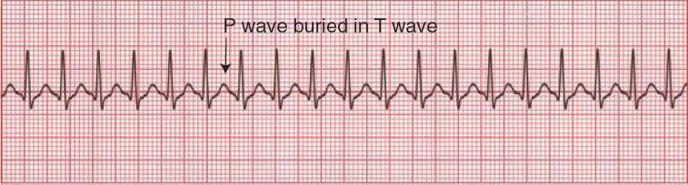 Paroksismal Supraventriküler Taşikardi His bandı bifurkasyonu yukarısındaki ektopik pacemaker veya reentry odaktan kaynaklanır.