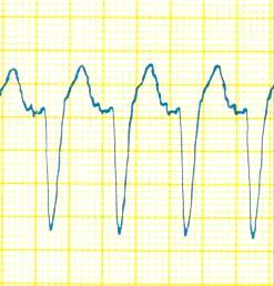 EKG disritmiler