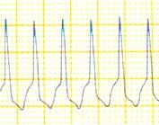 DİSRİTMİ QRS < 0.