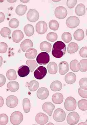 Lökosit sayısı 15 000-100 000/mm 3 Lenfositoz vardır Lenfositler T ve B hücre kökenli Normal küçük hücreler Atipik lenfosit görülmez Erişkinlerde ve kısmen bağışıklığı olan