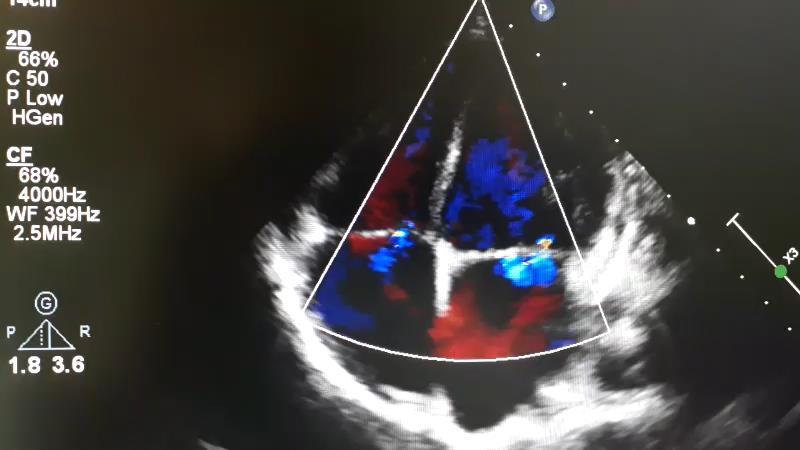 Pulmoner Venöz Dönüş: normal Atriyoventriküler bağlantı: Konkordan Ventriküloarteriyel bağlantı: Konkordan İnteratriyal septum PFO Mitral kapak anatomik olarak normal görünümde, darlık izlenmedi,