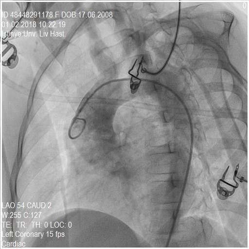 a Koroner Anjiografi Bilateral koroner arter ve dallarında akım normal Darlık izlenmedi Sağ subklavian arterde darlık